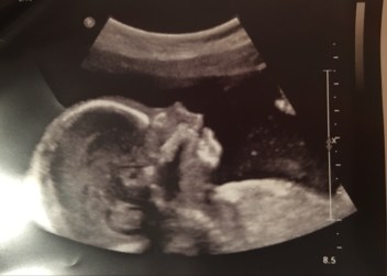 ultrasound-niko-e1536341429895.jpg